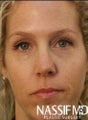 Female Revision Rhinoplasty