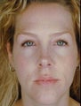 Female Revision Rhinoplasty