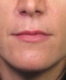 Lip Enhancement with Injectable Filler