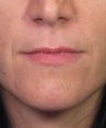 Lip Enhancement with Injectable Filler