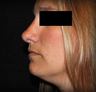Rhinoplasty