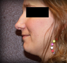 Rhinoplasty