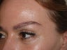 Hair Transplant