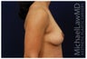 Breast Lift