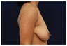 Breast Lift