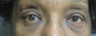 Lower eyelid bags removal