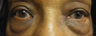 Lower eyelid bags removal