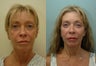 Facelift