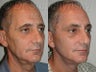 Endoscopic Mid Facelift, Blepharoplasty and Endoscopic Forehead Lift