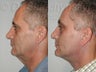 Endoscopic Mid Facelift, Blepharoplasty and Endoscopic Forehead Lift