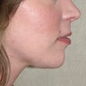 25 Year-old Treated for Small Chin