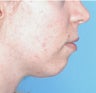 25 Year-old Treated for Small Chin
