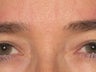 Botox to Treat Crow's Feet & Grouchy Look