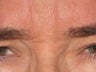 Botox to Treat Crow's Feet & Grouchy Look