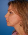 Chin Augmentation