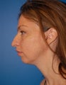 Chin Augmentation