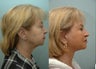 Facelift