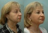Facelift