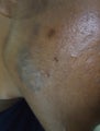 Acne keloids treated with Bleomycin