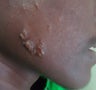 Acne keloids treated with Bleomycin