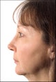 Rhinoplasty