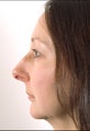 Rhinoplasty