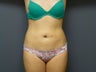 20 yo abdominal liposculpture