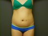 20 yo abdominal liposculpture