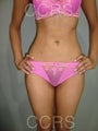 VASER lipo - 25 yrs old model (abdomen & flanks)