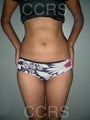 VASER lipo - 25 yrs old model (abdomen & flanks)