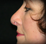 Rhinoplasty