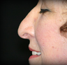 Rhinoplasty