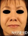 Hispanic Primary Rhinoplasty