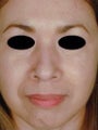 Hispanic Primary Rhinoplasty