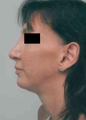 Chin Implant