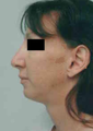 Chin Implant