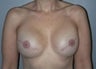 Female patient who underwent breast reconstruction