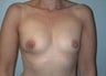 Female patient who underwent breast reconstruction