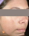 Female treated with 4 Photodynamic Therapy with Levulan for acne