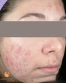 Female treated with 4 Photodynamic Therapy with Levulan for acne