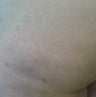 Cellulite Treatment