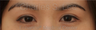 Asian Eyelid Surgery