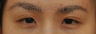 Asian Eyelid Surgery