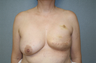 Breast Reconstruction