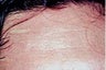 Male Botox