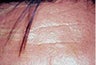 Male Botox
