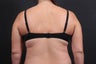 This 39 year old female underwent the Bra Line Back Lift procedure