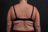This 39 year old female underwent the Bra Line Back Lift procedure