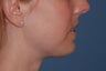 Female Chin Enhancement