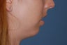 Female Chin Enhancement